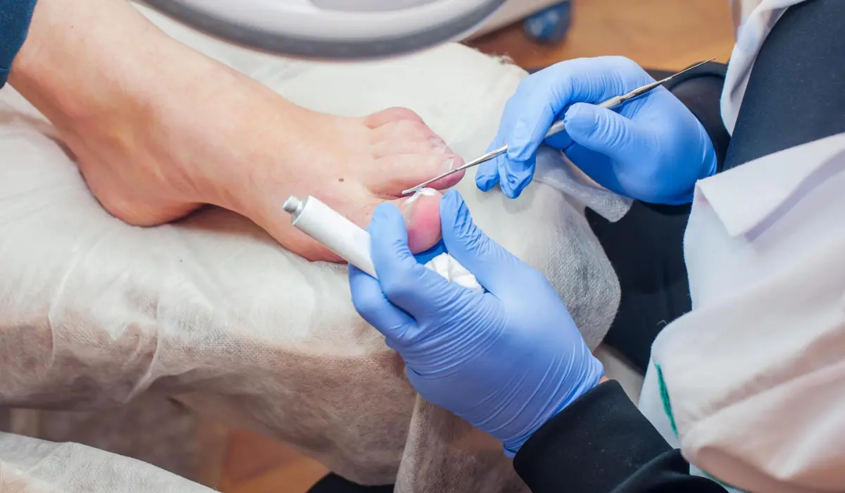 Best Toenail Fungus Treatments