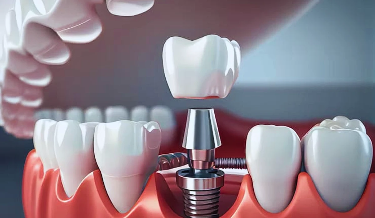 Endosteal Implant