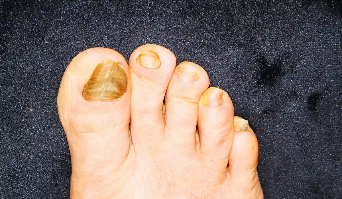 Green Nail Fungus