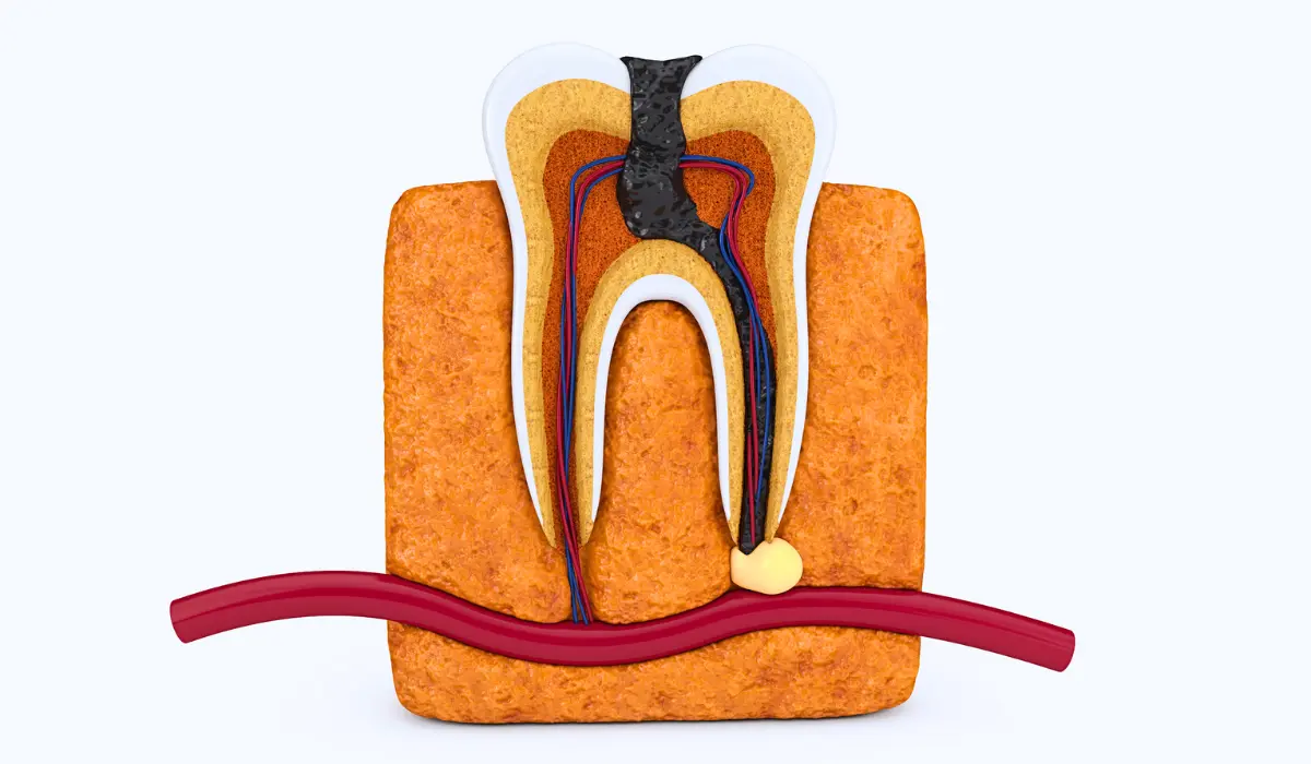 Kill Tooth Pain Nerve in 3 seconds