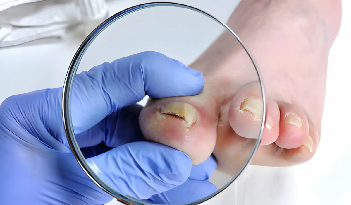 New Prescription Medications For Toenail Fungus