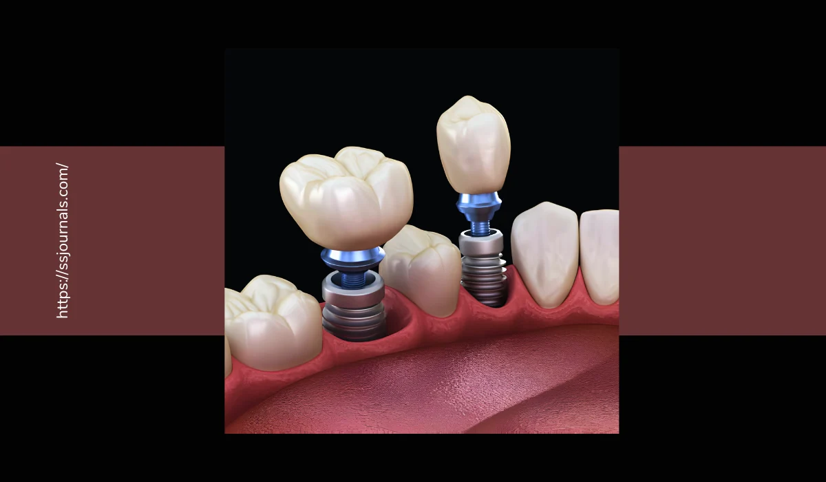 What Are Endosteal Implants