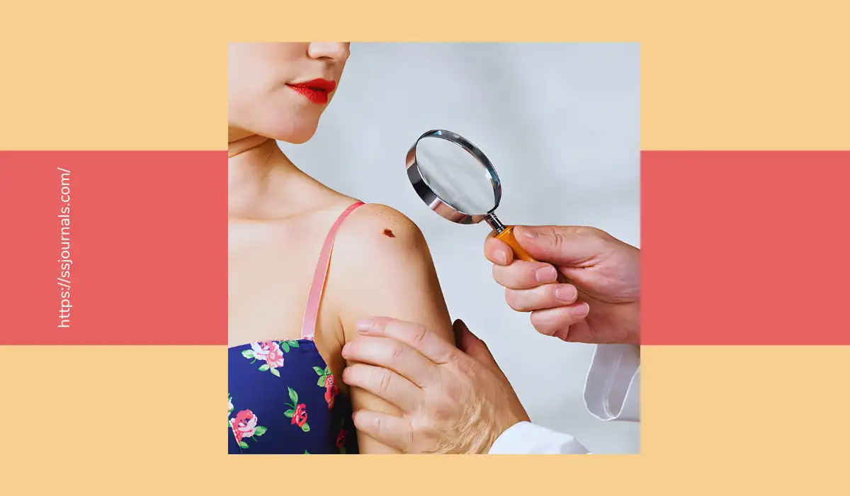 Melanoma Skin Cancer