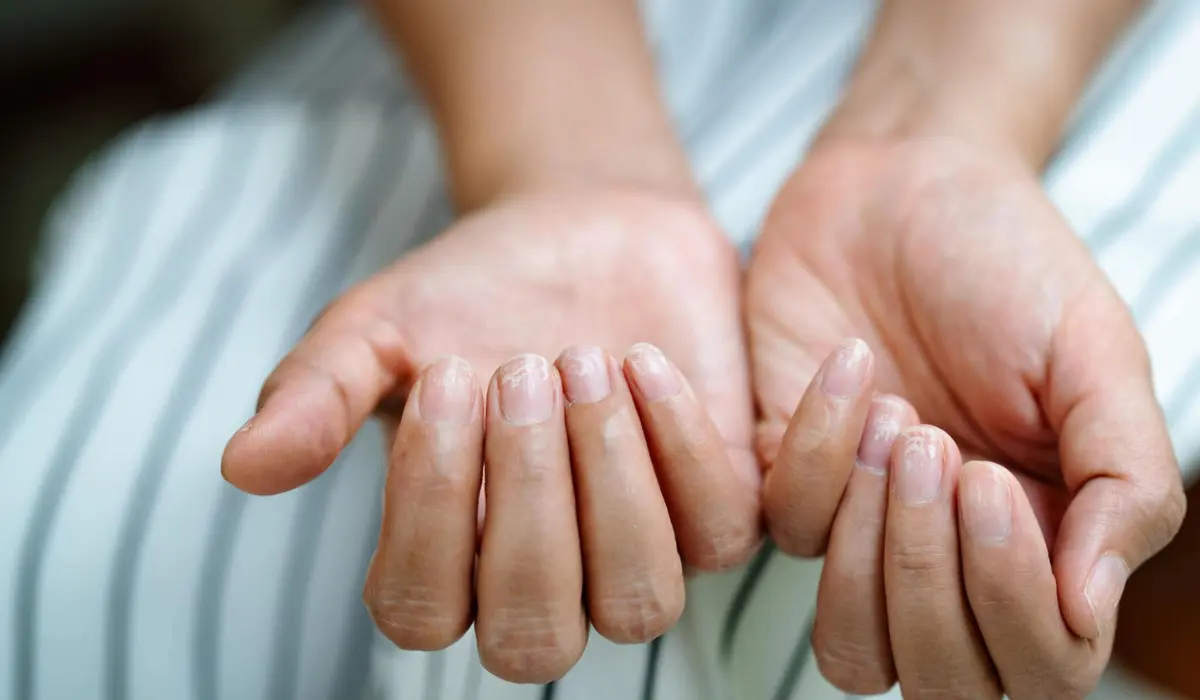 Must Knows On Fingernail Fungus