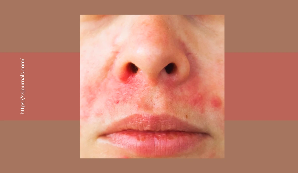 Perioral dermatitis healing Signs