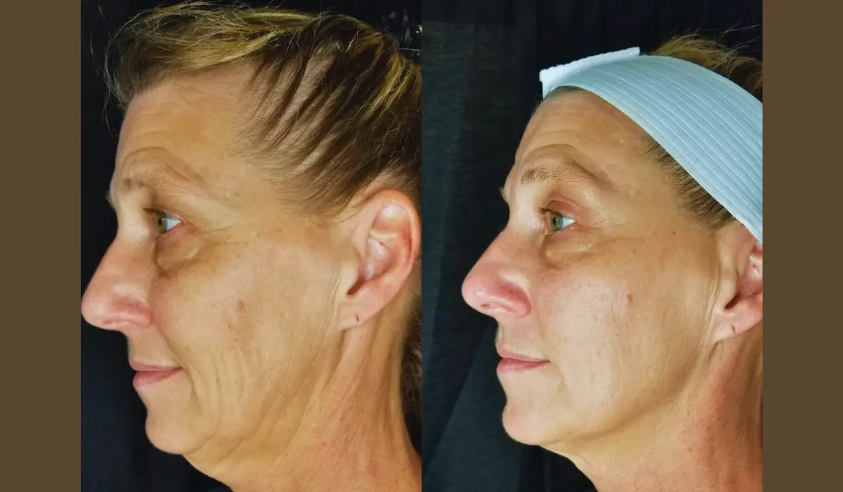 Cryo T-Shock Facial